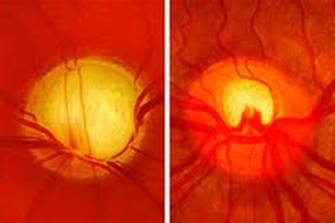 Best cataract eye drops, glaucoma, non-carnosine , c – Anatomi