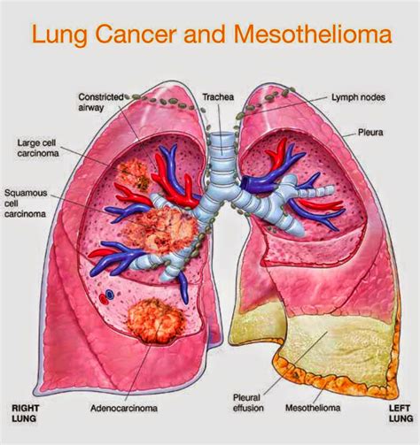 Pathophysiology of Mesothelioma