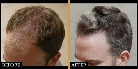 Before & After - Hair Restoration Houston