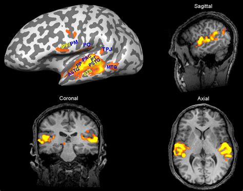 Auditory Cortex Mri