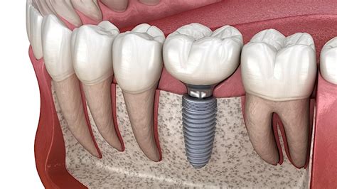 AOS (NSW) 1/2-Day Dinner Meeting (Implant Complications) - AOS NSW