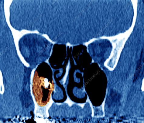 Sinusitis, head CT scan - Stock Image - M260/0238 - Science Photo Library