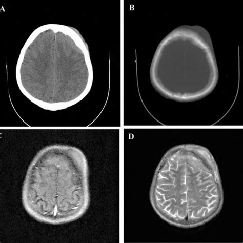 Axial CT scan (A,B), a calvarial lesion with both extra-and ...