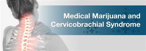 Cervicobrachial Syndrome – Marijuana Doctors | Online Medical Card Directory