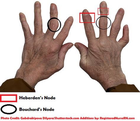 Osteoarthritis vs. Rheumatoid Arthritis NCLEX Review