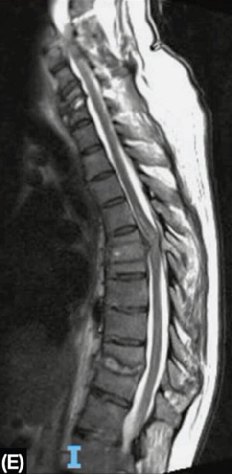 MRI showing the cervical, thoracic, and lumbar spine. (a, b) At the... | Download Scientific Diagram