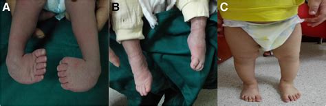 A polyaxial fixation brace for the treatment of idiopathic congenital talipes equinovarus in ...