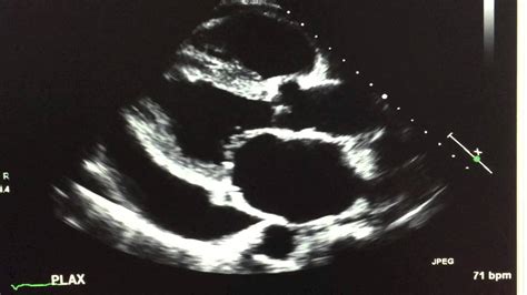 2D echocardiogram showing a large pericardial effusion - YouTube