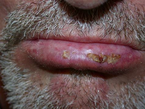 Actinic Cheilitis: Pictures, Lip Changes, and Treatment