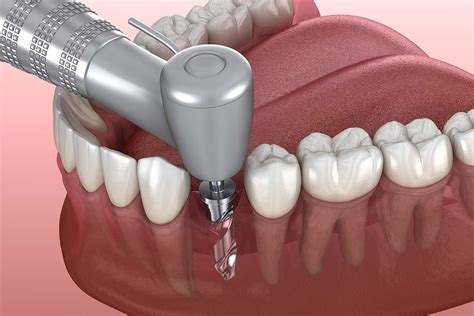 Colocación de implantes dentales paso a paso | Mtnez. Avilés