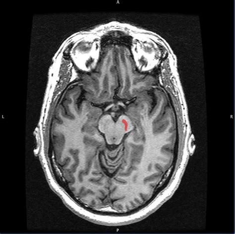 Scientific Discovery May Change Treatment of Parkinson's - Neuroscience ...