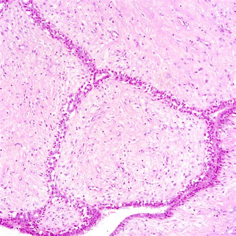 Pathology Outlines - Phyllodes tumor