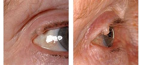 A benign or malignant eyelid lump – can you tell? An unusual collision tumour highlighting the ...