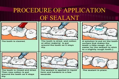 Pit and fissure sealants