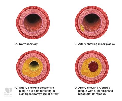 Angina - Melbourne Heart Care