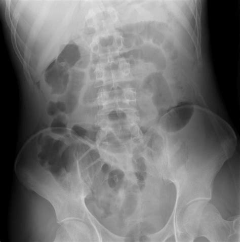 Intestinal Perforation- Pneumoperitoneum – Undergraduate Diagnostic Imaging Fundamentals