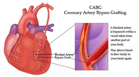 Clinical Exercise and Cardiac Rehab | CABG