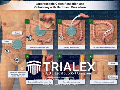 Laparoscopic Colon Resection and Colostomy with Hartmann Procedur...