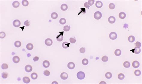 Heinz Bodies – Cells and Smears