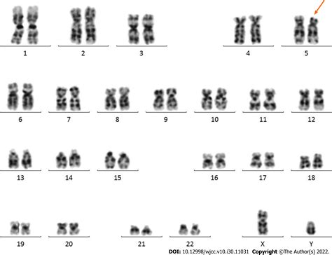 Neonatal Cri du chat syndrome with atypical facial appearance: A case ...