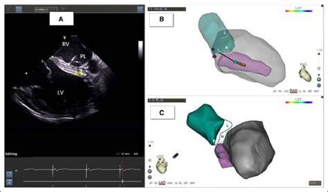 Implantation of the left bundle branch lead under intracardiac... | Download Scientific Diagram