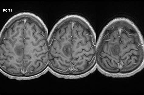 Dr Balaji Anvekar FRCR: Parietal lobe lesion on MRI