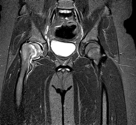 Slipped Upper Femoral Epiphysis-MRI - Sumer's Radiology Blog