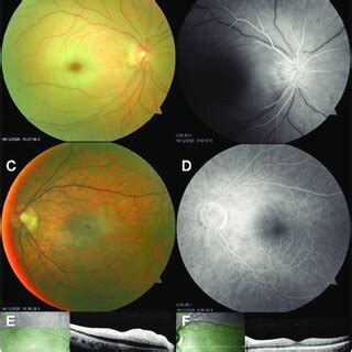 Fundus photography, fundus fluorescein angiography, and optical... | Download Scientific Diagram