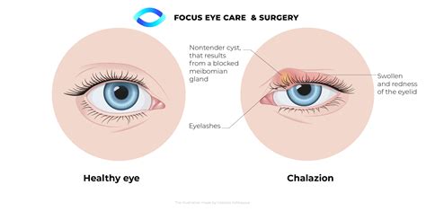 Chalazion Treatment Queens NYC Long Island NY