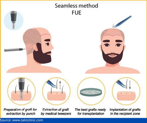 How Effective Are Various Hair Transplant Techniques? | KDC