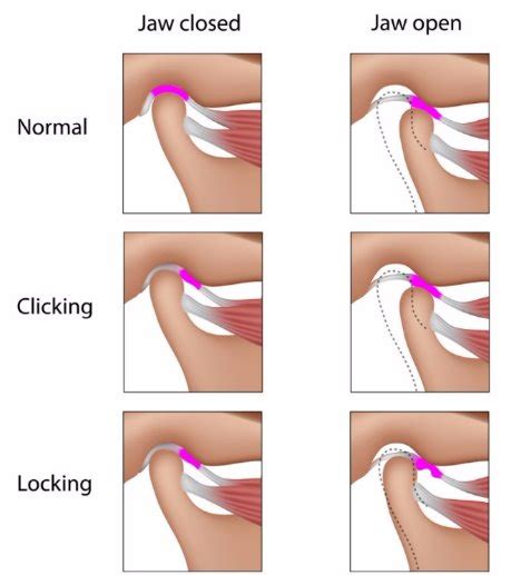 Why Does Your Jaw CLICK or POP? - Functional Performance Physical TherapyFunctional Performance ...