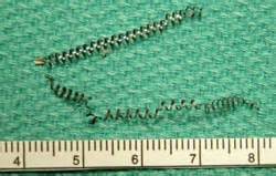 Essure And Pregnancy: Essure Reversal Works!