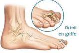 Opération orteil en griffe (ou en marteau) - Chirurgie du pied