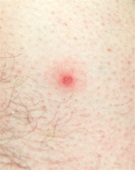 Lyme Disease becomes personal | A tick bite can change thing… | Flickr