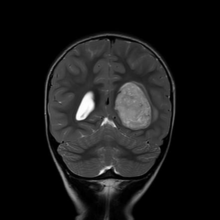 Atypical choroid plexus papilloma | Image | Radiopaedia.org