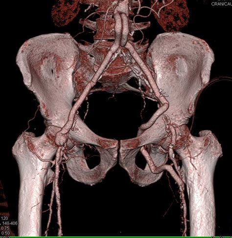 Femoral Artery Bypass thru the Obturator Foramen - Vascular Case Studies - CTisus CT Scanning