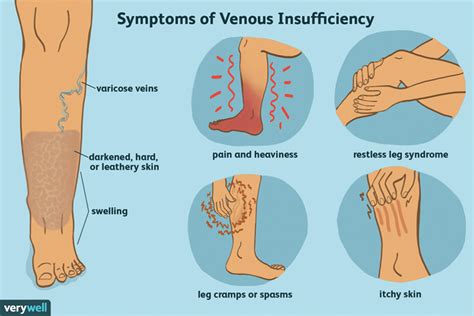 Understanding Chronic Venous Insufficiency | Senior News and Living