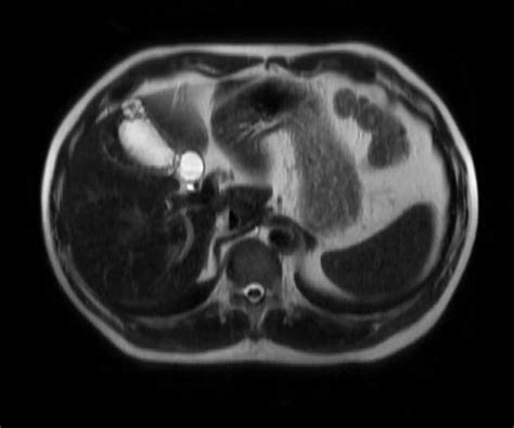 Gallbladder adenomyomatosis | Radiology Case | Radiopaedia.org MRI Pearl necklace sign ...