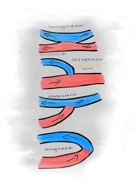 Arteriovenous Fistula Ultrasound: How, What, Where?