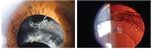 Managing Pseudoexfoliation During Cataract Surgery