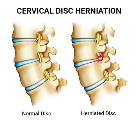 Cervical Disc Herniation Doctors NJ & NYC