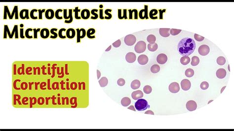 Macrocytosis under microscope | Macrocytosis rbc - YouTube