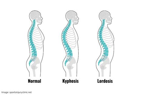 How to Fix Lordosis: Doctor-Recommended Lordosis Treatment – BackEmbrace