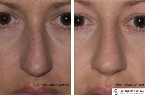 Do I need a septoplasty with cosmetic rhinoplasty? – Potomac Plastic Surgery