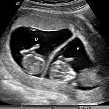 20 Weeks Pregnant With Twins Ultrasound