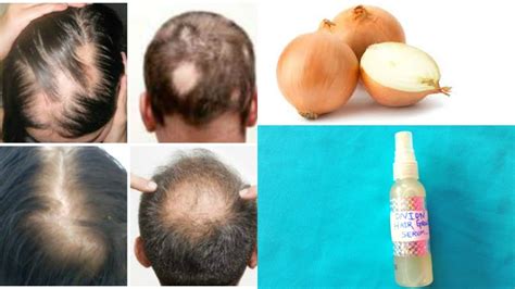 100% Hair Growth (Scientifically Proven) || Best Hair Loss Treatment For Alopecia & Baldness ...