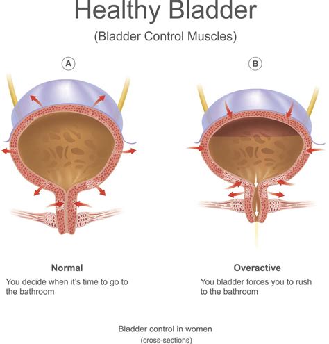 What Causes Bladder Leakage? - Beautikini Fashion Blog