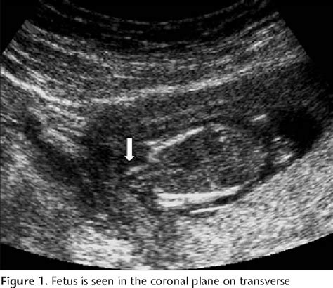 Figure 2 from Ultrasonographic prenatal diagnosis of isolated acephaly ...