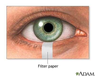 Schirmer test | UF Health, University of Florida Health