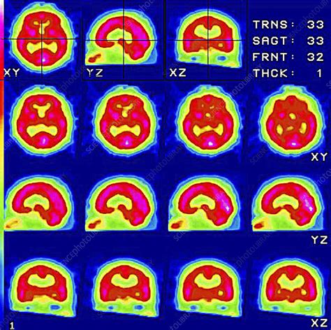 Healthy brain, SPECT scans - Stock Image - P332/0424 - Science Photo Library